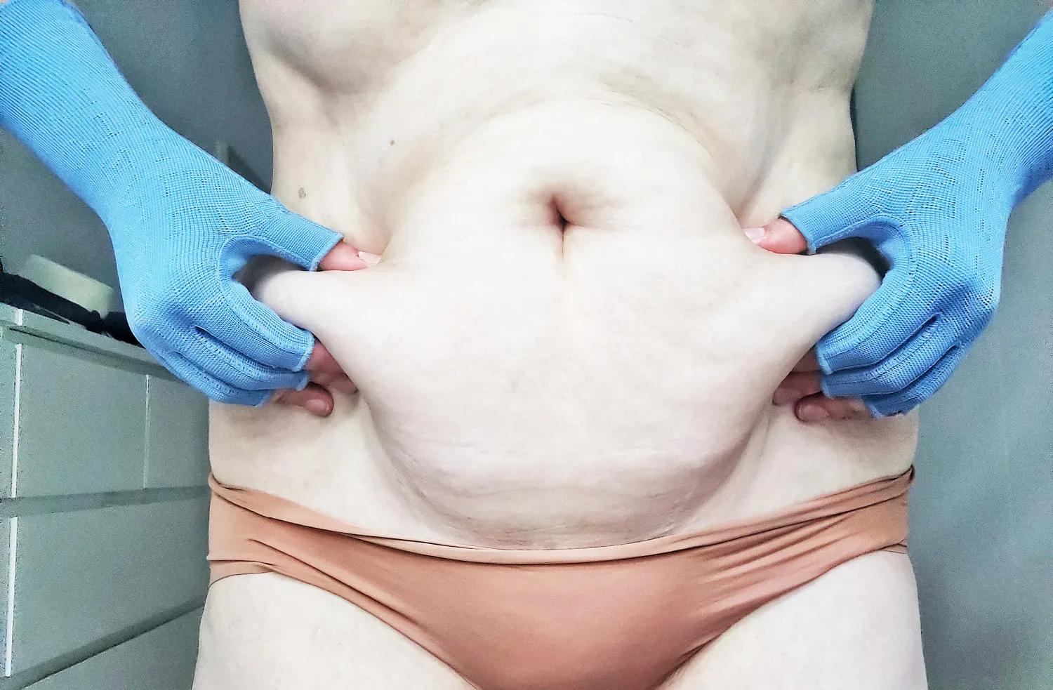 Ketogene Ernährung mit Lipödem: Abnehm Projekt #viertelsprotte – Teil 1