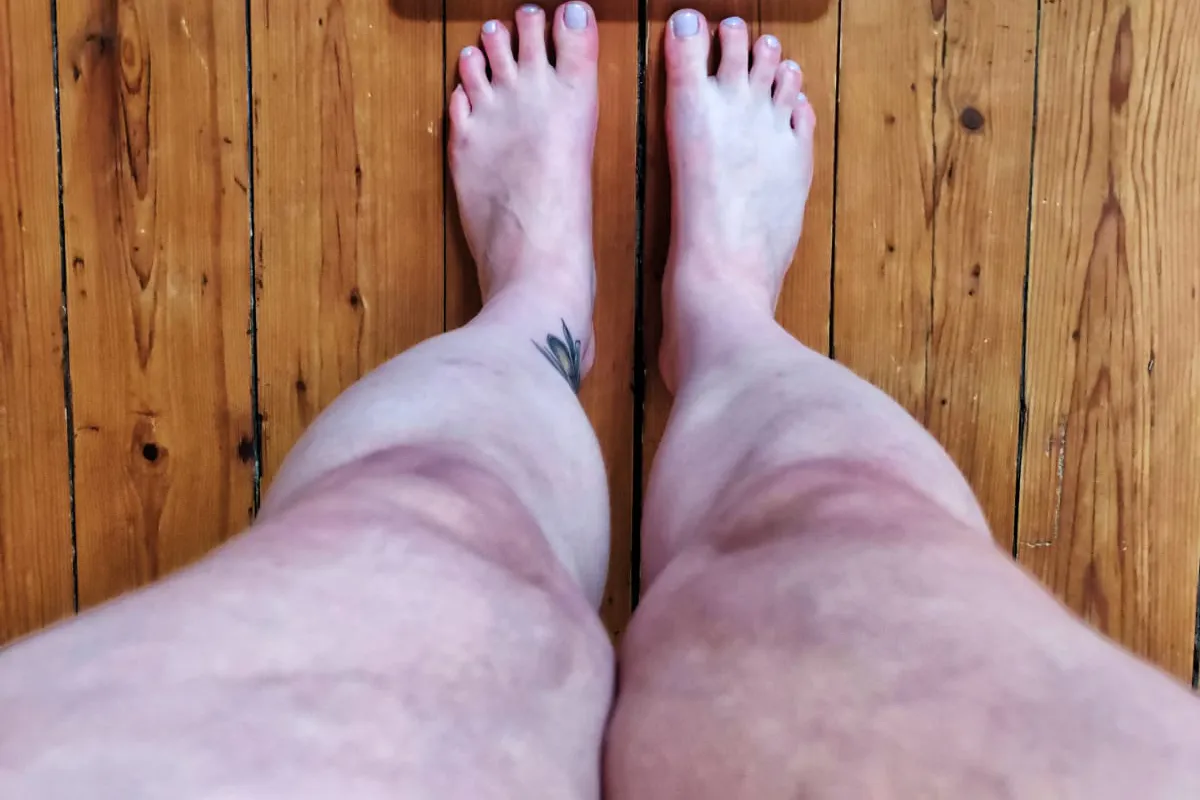 Wie ein Lipödem Ernährungsplan mein Leben veränderte