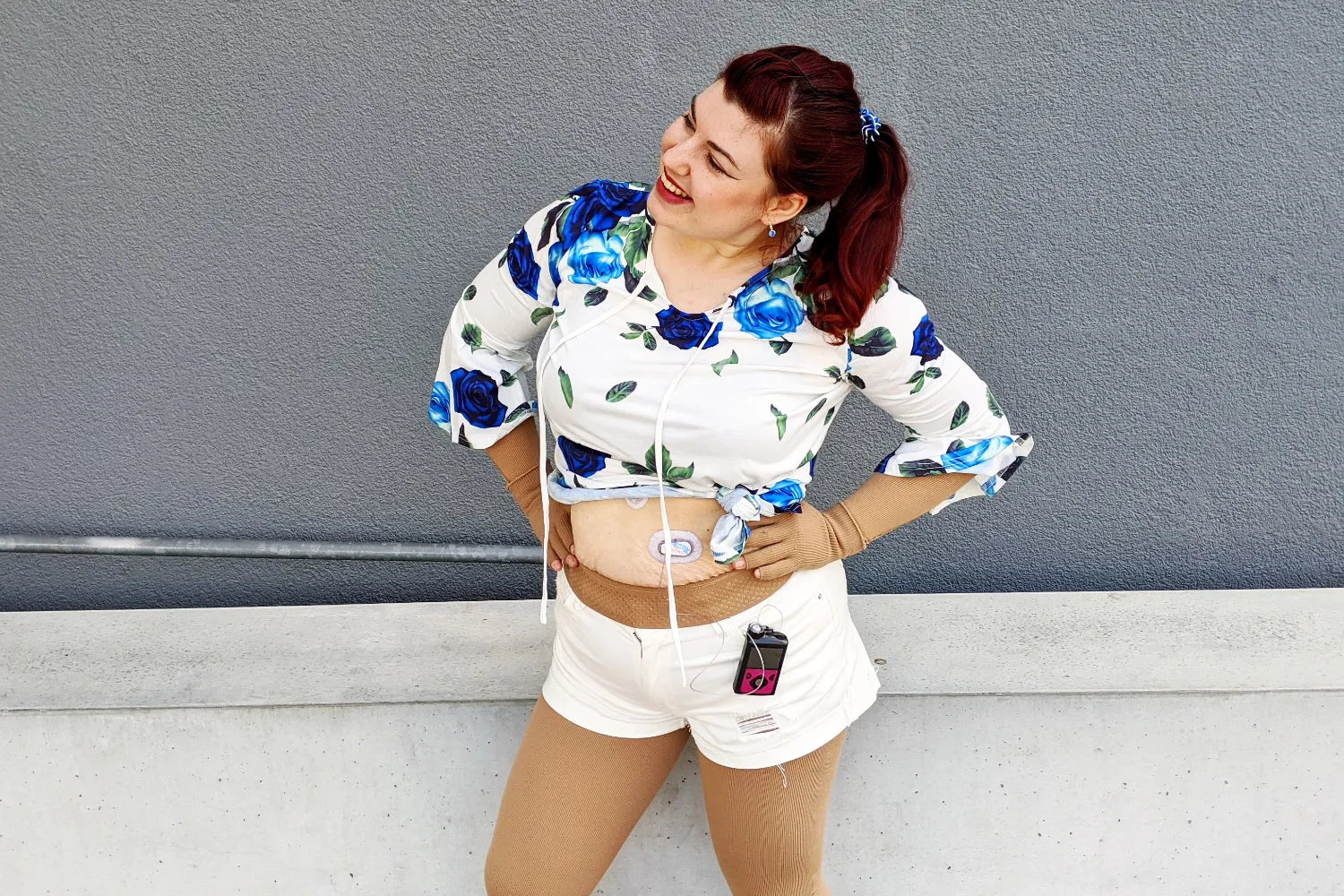 Lipödem und Diabetes – Ein Teufelskreis!